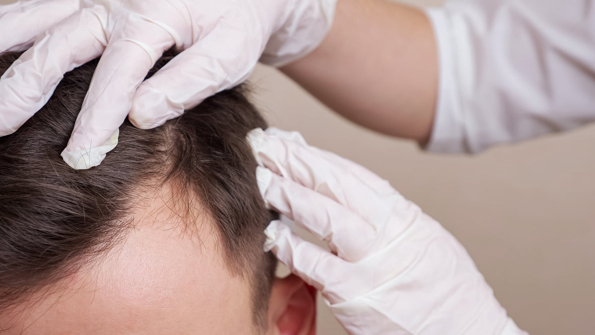 Chute de cheveux et testostérone : ce qu'il faut vraiment savoir